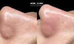 Какую чистку лица выбрать?